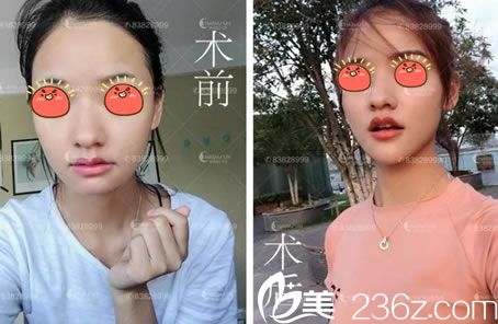 杭州詮昕玻尿酸豐下巴<span style= 杭州詮昕玻尿酸豐下巴<span style=