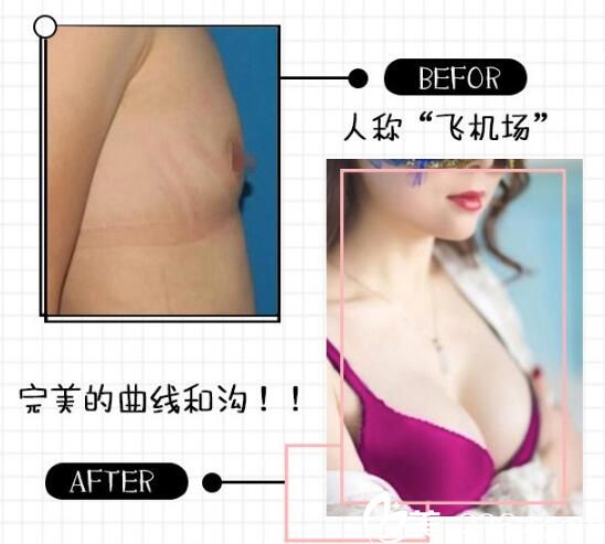 南京施爾美隆胸案例