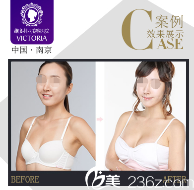 南京維多利亞隆胸案例