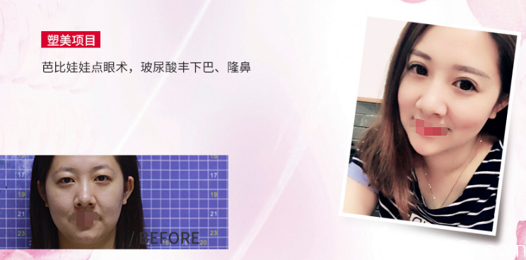 隆鼻+豐下巴+雙眼皮案例