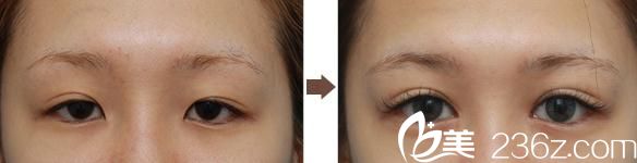 全切雙眼皮