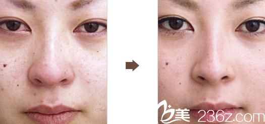 山根縮小術(shù)