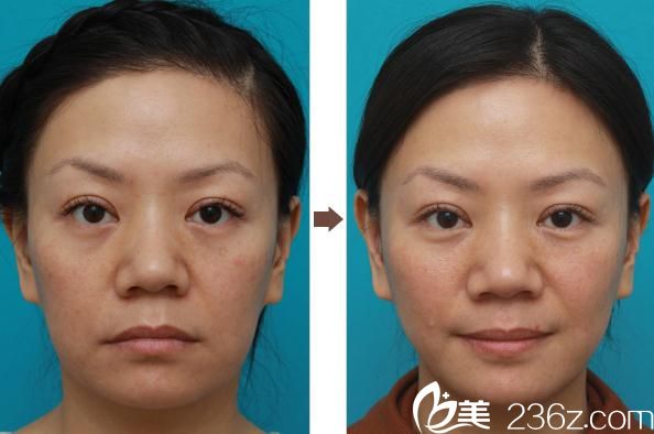 面部拉皮手術(shù)