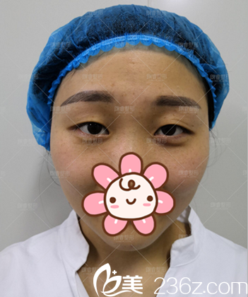 綿陽朗睿切開雙眼皮術(shù)前照片 綿陽朗睿切開雙眼皮術(shù)前照片