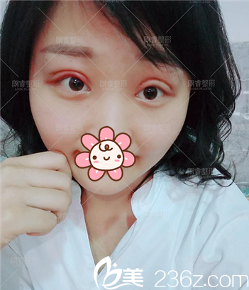 切開雙眼皮術(shù)后天眼睛腫脹 切開雙眼皮術(shù)后天眼睛腫脹