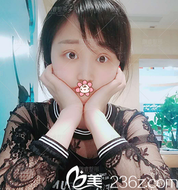 切開雙眼皮術(shù)后7天照片 切開雙眼皮術(shù)后7天照片