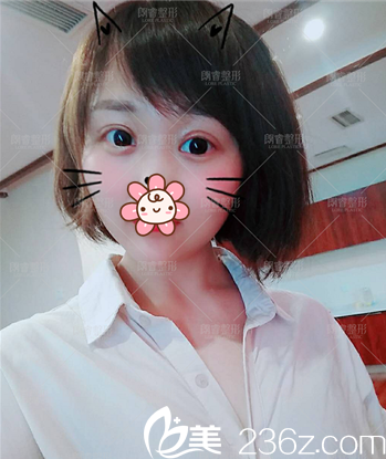 在綿陽朗睿咨詢后認同醫(yī)生方案就找劉峰做了切開雙眼皮，分享下術后效果