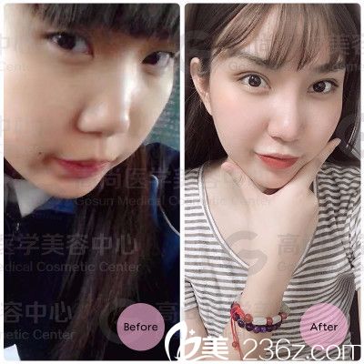 <!--<i data=20240703-sp></i>-->余文林醫(yī)生做的雙眼皮案例 <!--<i data=20240703-sp></i>-->余文林醫(yī)生做的雙眼皮案例