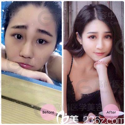 <!--<i data=20240703-sp></i>-->余文林醫(yī)生隆鼻案例 <!--<i data=20240703-sp></i>-->余文林醫(yī)生隆鼻案例