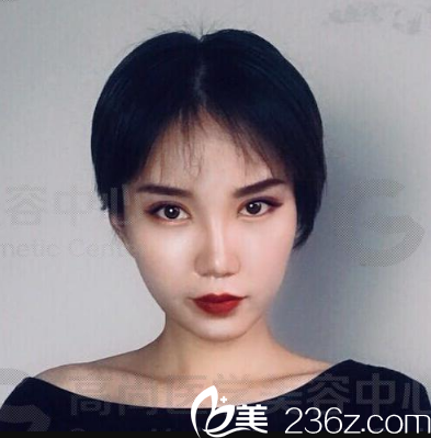 <i data-id='d14287f5-e46a-4664-98e9-58950ee2f6a3' style='display:none;'></i><i data-id='92a36f34-e910-4667-a860-8a0610a313c1' style='display:none;'></i>余文林雙眼皮隆鼻術(shù)后15天 <i data-id='d14287f5-e46a-4664-98e9-58950ee2f6a3' style='display:none;'></i><i data-id='92a36f34-e910-4667-a860-8a0610a313c1' style='display:none;'></i>余文林雙眼皮隆鼻術(shù)后15天