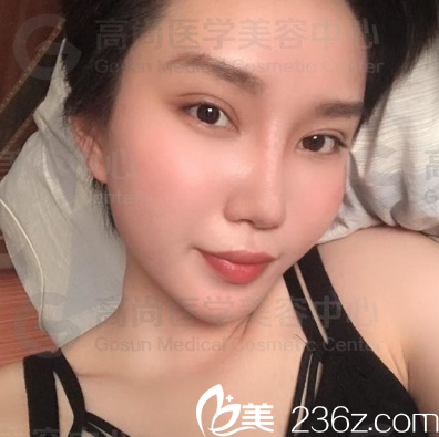 廣州高尚醫(yī)學(xué)美容中心余文林醫(yī)生做的雙眼皮案例 廣州高尚醫(yī)學(xué)美容中心余文林醫(yī)生做的雙眼皮案例