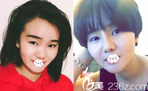 淮北東方美萊塢鼻綜合隆鼻真人案例