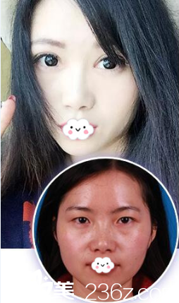 淮北時光雙眼皮+開眼角真人案例效果圖