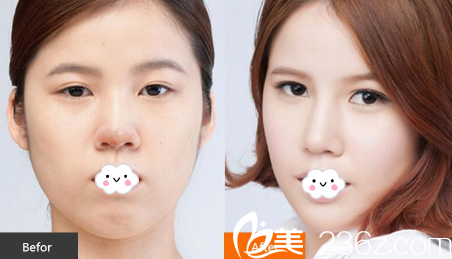 淮北時光假體隆鼻失敗修復(fù)真人案例