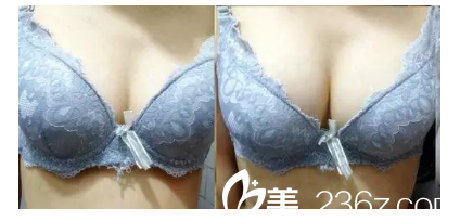 張書明醫(yī)生豐胸案例