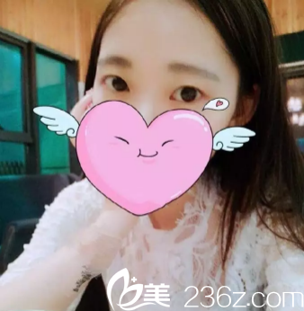 在寶雞韓美做雙眼皮的術(shù)前照片 在寶雞韓美做雙眼皮的術(shù)前照片