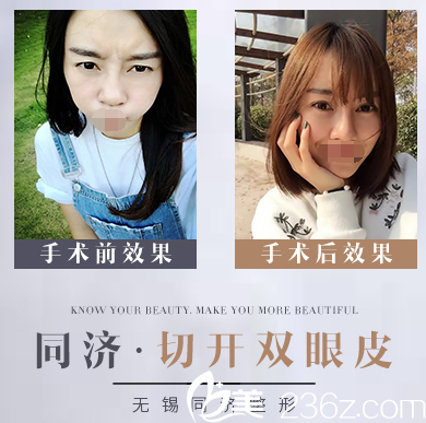 無錫同舟醫(yī)療美容醫(yī)院雙眼皮案例 無錫同舟醫(yī)療美容醫(yī)院雙眼皮案例