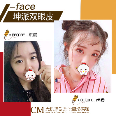 無錫坤如瑪麗整形醫(yī)院雙眼皮案例 無錫坤如瑪麗整形醫(yī)院雙眼皮案例