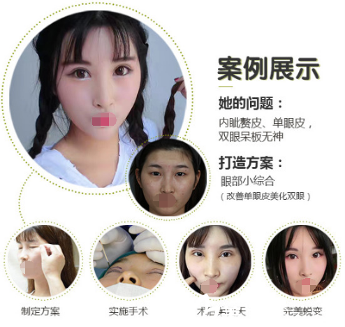 <!--<i data=20240703-sp></i>-->美聯(lián)臣整形醫(yī)院雙眼皮案例 <!--<i data=20240703-sp></i>-->美聯(lián)臣整形醫(yī)院雙眼皮案例