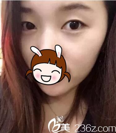 糾結(jié)做全切還是韓式定位雙眼皮 糾結(jié)做全切還是韓式定位雙眼皮