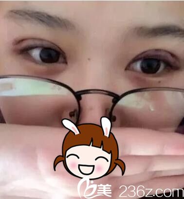 剛做完韓式三點雙眼皮 剛做完韓式三點雙眼皮