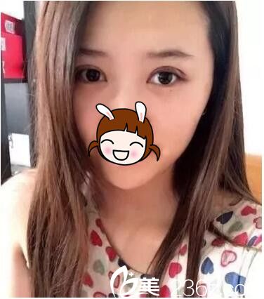 術(shù)后2天雙眼皮恢復(fù)中 術(shù)后2天雙眼皮恢復(fù)中