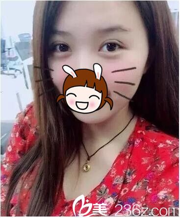 一周韓式雙眼皮恢復(fù) 一周韓式雙眼皮恢復(fù)