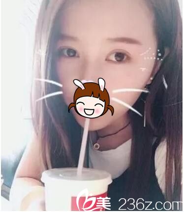 韓式三點定位雙眼皮術(shù)后半個月恢復(fù) 韓式三點定位雙眼皮術(shù)后半個月恢復(fù)