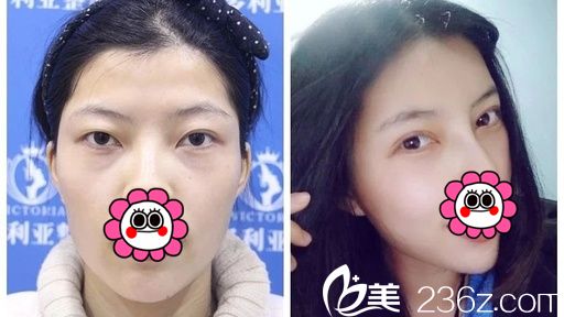 襄陽維多利亞雙眼皮案例