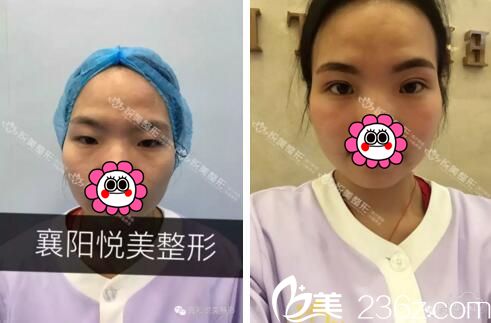 襄陽悅美雙眼皮案例