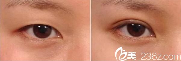 襄陽伊萊美雙眼皮案例