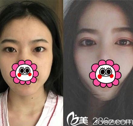 襄陽韓蔻雙眼皮真人案例