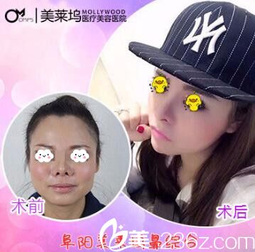 阜陽東方美萊塢鼻綜合隆鼻整形真人案例