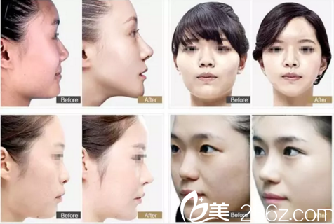 佳木斯隆鼻真人案例