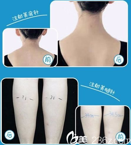智海玲注射瘦肩和瘦腿案例
