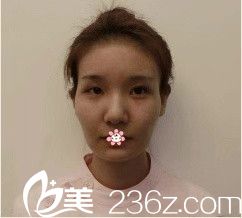 術(shù)前我看著顯老 術(shù)前我看著顯老