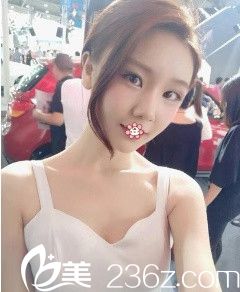 <!--<i data=20240703-sp></i>-->美萊楊繼紅自體脂肪填充術(shù)后一個(gè)月 <!--<i data=20240703-sp></i>-->美萊楊繼紅自體脂肪填充術(shù)后一個(gè)月