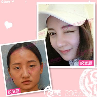 廣<!--<i data=20240703-sp></i>-->寧東方整形醫(yī)院<!--<i data=20240703-sp></i>-->做的隆鼻案例