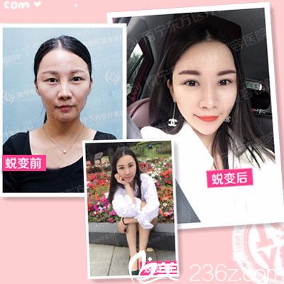 南寧東方整形醫(yī)院<!--<i data=20240703-sp></i>-->做的雙眼皮案例