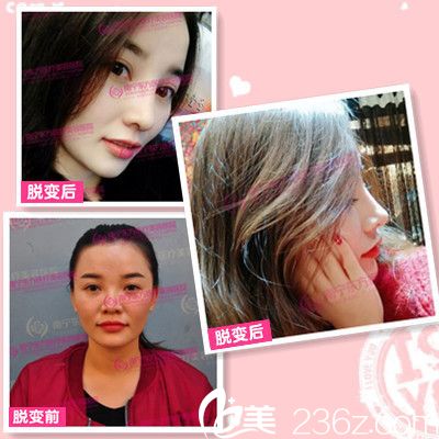 廣<!--<i data=20240703-sp></i>-->寧東方整形醫(yī)院趙波做的隆鼻案例