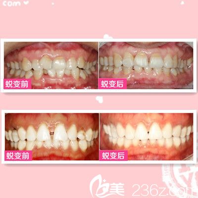 廣<!--<i data=20240703-sp></i>-->寧東方整形醫(yī)院牙齒矯正案例