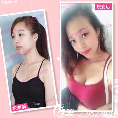 南寧東方整形醫(yī)院趙波做的自體脂肪隆胸案例