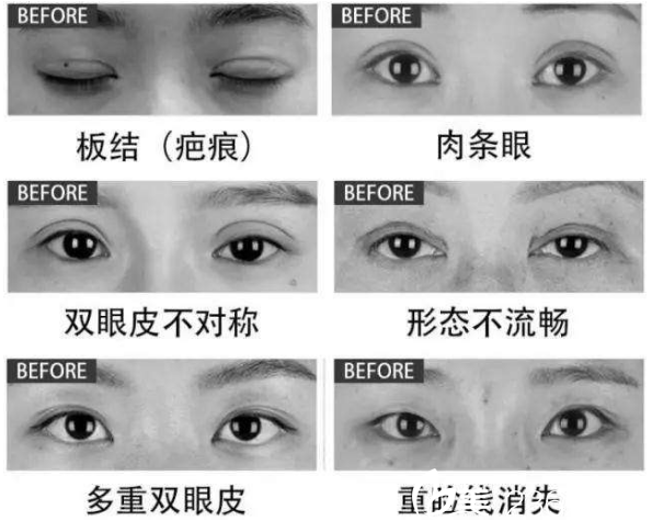 雙眼皮失敗常見的情況
