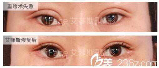 雙眼皮太寬，肉條感明顯修復(fù)案例