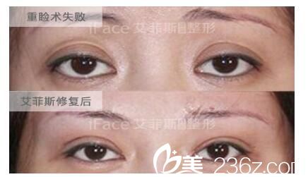 寬度不合適，雙眼皮無(wú)神修復(fù)案例