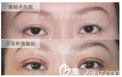 術(shù)前雙眼皮線幾乎消失，眼皮松弛修復(fù)案例