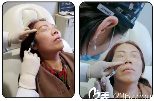 玻尿酸填充太陽穴和靜態(tài)皺紋中