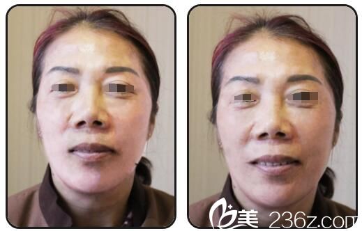 在揚州艾菲斯做玻尿酸+瘦臉除皺聯(lián)合除皺 一覺醒來告別了法令紋、抬頭紋、魚尾紋、川字紋....