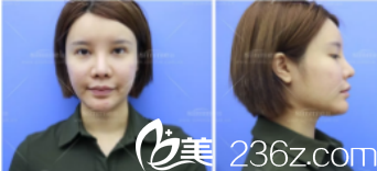 欣茜術(shù)前照 欣茜術(shù)前照