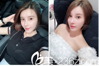 去年花了4000大洋在淄博美冠臣美容醫(yī)院做了鼻綜合手術(shù)，從拆線(xiàn)后到現(xiàn)在總是忍不住拍照片